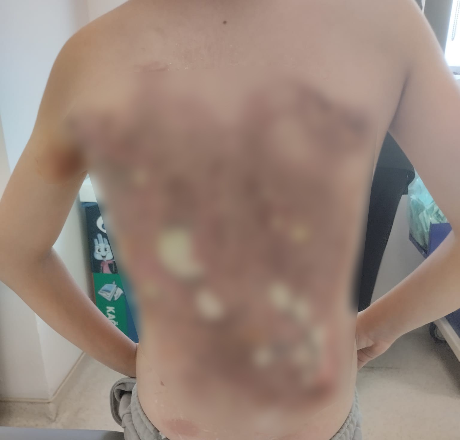 Arnavutköy’de akran zorbalığı iddiası: 12 yaşındaki çocuğun sırtını kolonya ile yaktılar